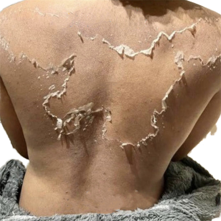 Peeling Oil