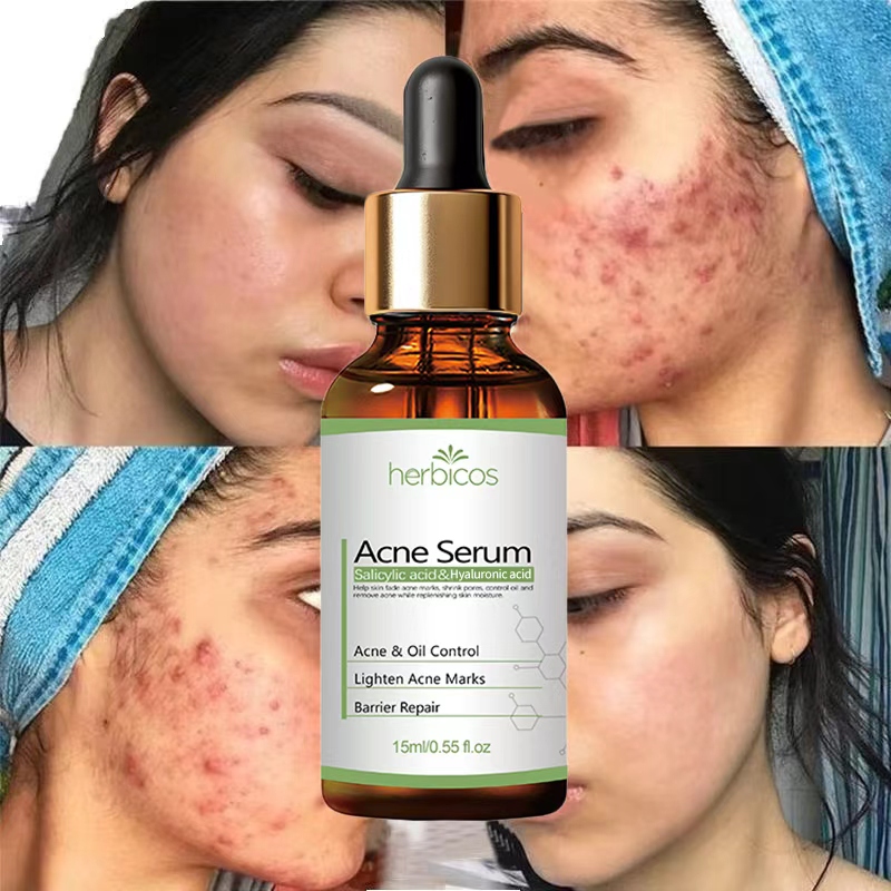 2% Salicylic Acid Acne Treatment Essence